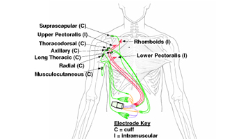 Functional Electrical Stimulation