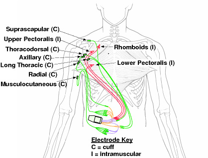 https://robotics.northwestern.edu/images/research/topics/functional-electric-stimulation/implanted-neuroprosthesis.png